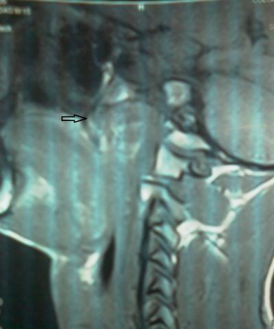 Figure 1: A sagittal view of preoperative CT scan showing a tumour occupying the nasopharyngeal space (arrow)
